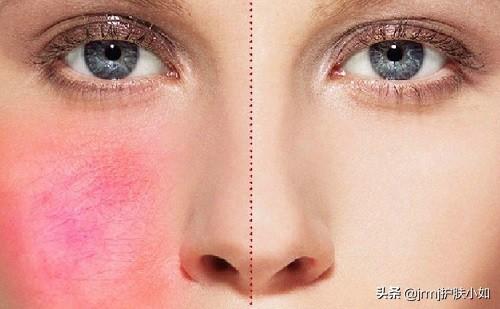 脸部红血丝能去除吗(脸部红血丝怎么祛除？或许这8个方法可以帮到你)
