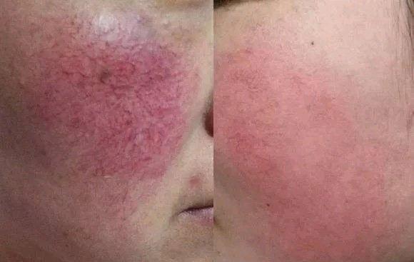 眼球红血丝能去除吗(红血丝不及时处理，会蔓延，看看自己属于哪类才能针对性修复)