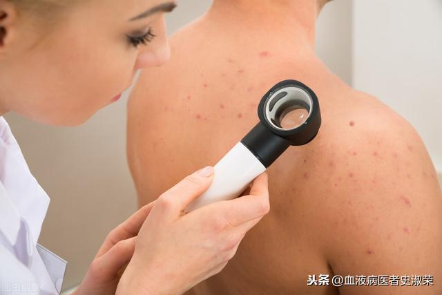 性色素(「疾病认识」什么是色素性紫癜？严重吗？)