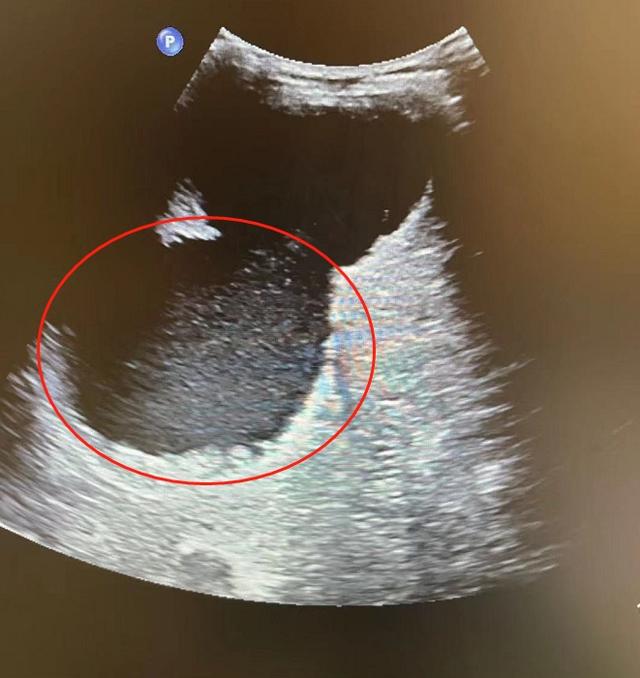 引流是什么病(肝上长18厘米巨大囊肿 置管引流5天才排净)