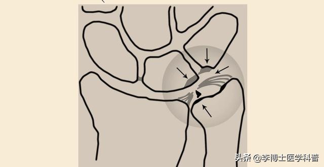 tfcc损伤(原创科普：还有一种腕关节疼痛、无力叫做三角纤维软骨复合体损伤)