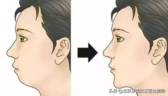 正畸前后对比(戴过牙套（矫正牙齿）的人脸型都变了吗？)
