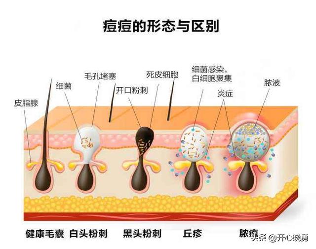 专业祛斑加盟连锁哪家好(揭秘祛斑祛痘加盟选品牌的小诀窍)