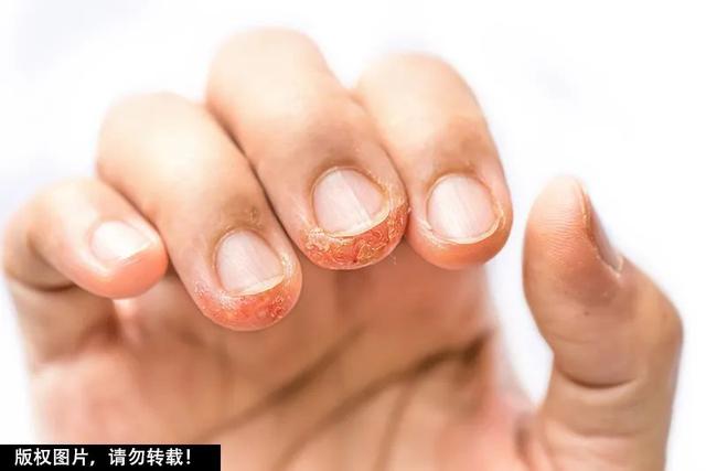 季节性手脱皮如何治疗(太折磨人了！一到换季手就脱皮，到底怎么回事？原因竟不只是缺维生素)