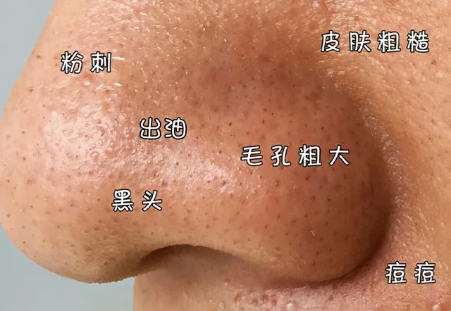 春雨面膜怎么样功效(韩国春雨茄子面膜，深层清洁皮肤又能去黑头又能养肤的清洁泥膜)