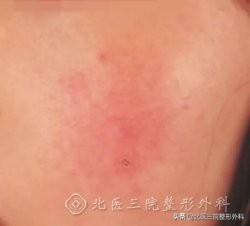 怎样去除脸上红血丝(面部红血丝怎么治疗？)