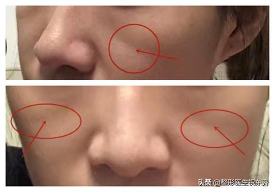 剥离微整的利弊(印第安纹是天生的，还是人老了长的？为何医生不建议填充？)