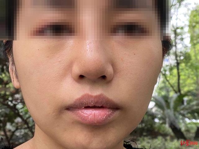 花呗分期怎么取消掉(花两万多元贷款分期做的鼻子却歪了？美容机构：只能修复，退3000元)