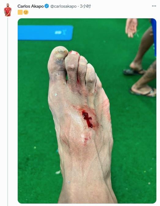 孩子脚被踩了(加的斯球员遭阿扎尔踩到脚面，赛后晒伤口照)